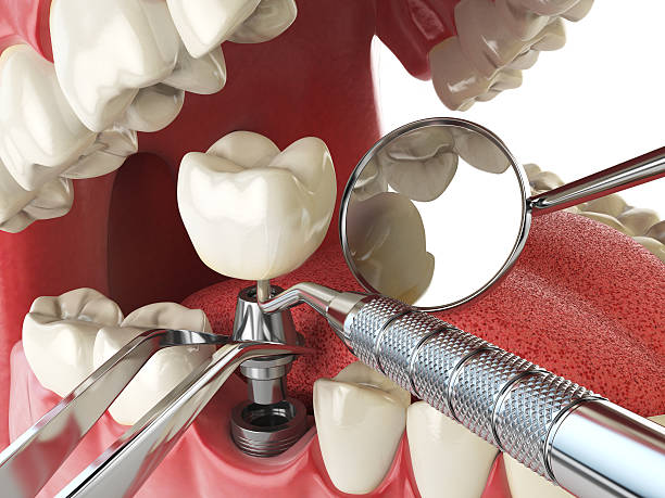 Best Emergency Tooth Extraction in Pleasant Valley, WV